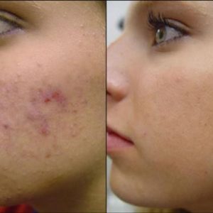Acne – Before and After